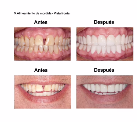 Carillas de Porcelana Smiles Peru (7) Carillas de Porcelana Smiles Peru (7)
