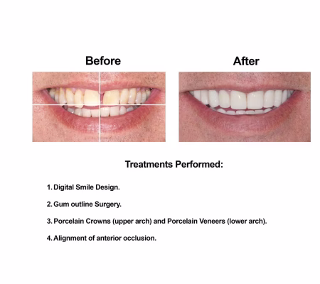 Cosmetic Dentistry and Rehabilitation Smiles Peru (2)