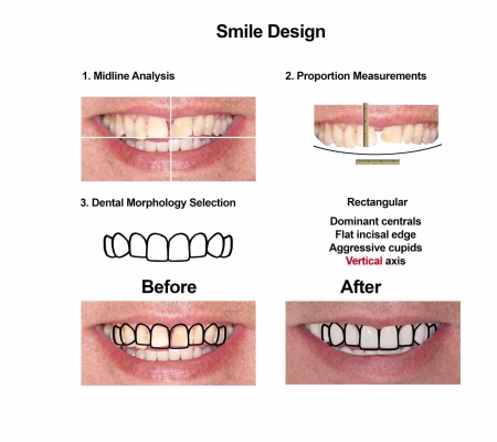 Cosmetic Dentistry and Rehabilitation Smiles Peru (3)