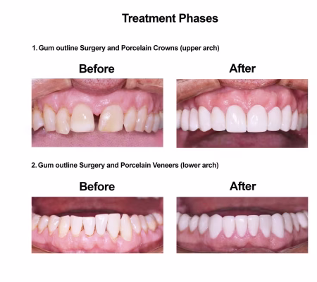Cosmetic Dentistry and Rehabilitation Smiles Peru (4)
