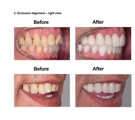 Cosmetic Dentistry and Rehabilitation Smiles Peru (5)