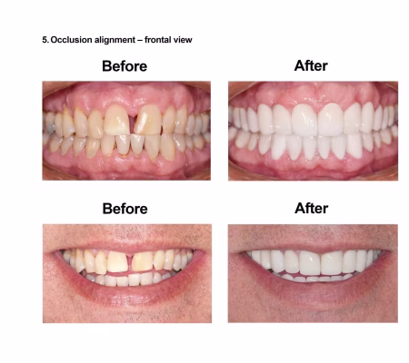 Cosmetic Dentistry and Rehabilitation Smiles Peru (7)