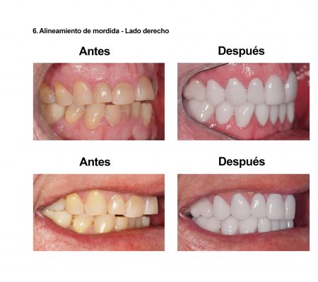 Estetica Dental Smiles Peru Carillas (2)