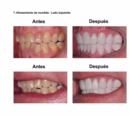 Estetica Dental Smiles Peru Carillas (3)