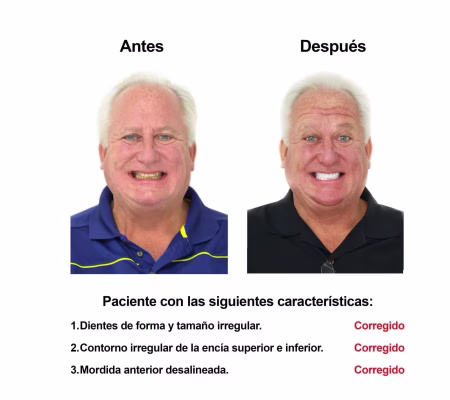 Estetica Dental Smiles Peru Carillas (4)