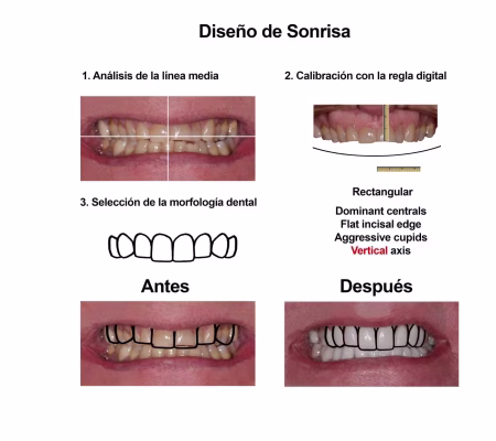 Estetica Dental Smiles Peru Carillas (5)