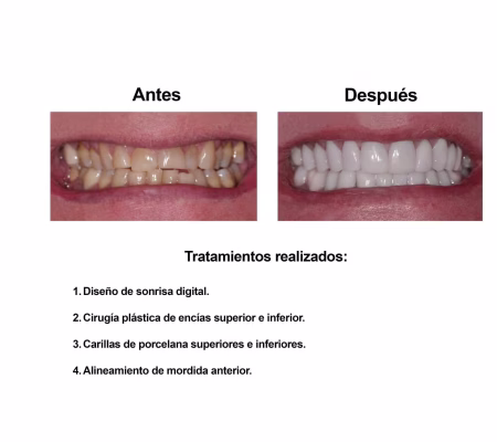 Estetica Dental Smiles Peru Carillas (6)