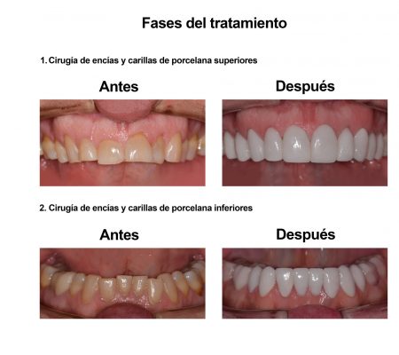 Estetica Dental Smiles Peru Carillas (7)