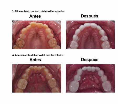 Estetica Dental Smiles Peru Carillas (8)