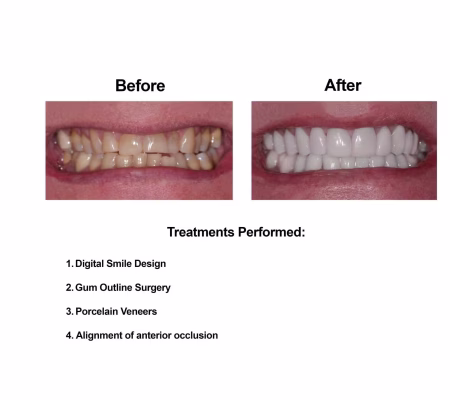 Porcelain Veneers Smiles Peru Cosmetic Dentistry (1) Porcelain Veneers Smiles Peru Cosmetic Dentistry (1)