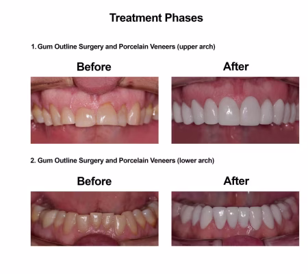 Porcelain Veneers Smiles Peru Cosmetic Dentistry (2) Porcelain Veneers Smiles Peru Cosmetic Dentistry (2)