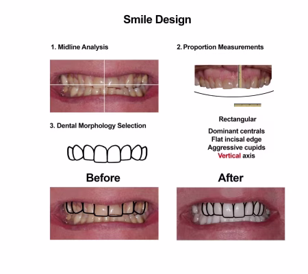 Porcelain Veneers Smiles Peru Cosmetic Dentistry (3) Porcelain Veneers Smiles Peru Cosmetic Dentistry (3)