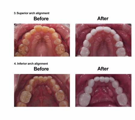 Porcelain Veneers Smiles Peru Cosmetic Dentistry (4) Porcelain Veneers Smiles Peru Cosmetic Dentistry (4)