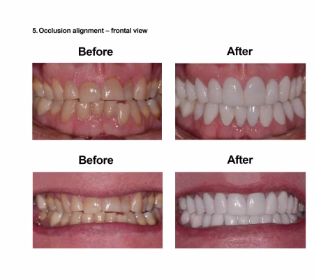 Porcelain Veneers Smiles Peru Cosmetic Dentistry (5) Porcelain Veneers Smiles Peru Cosmetic Dentistry (5)