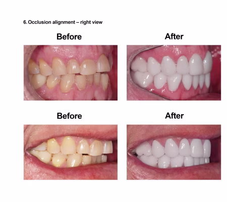 Porcelain Veneers Smiles Peru Cosmetic Dentistry (6) Porcelain Veneers Smiles Peru Cosmetic Dentistry (6)