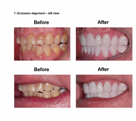 Porcelain Veneers Smiles Peru Cosmetic Dentistry (7) Porcelain Veneers Smiles Peru Cosmetic Dentistry (7)