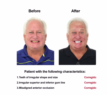 Porcelain Veneers Smiles Peru Cosmetic Dentistry Porcelain Veneers Smiles Peru Cosmetic Dentistry