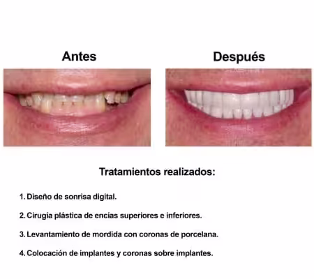 Rehabilitacion Oral e implantes dentales Smiles Peru (3) Rehabilitacion Oral e implantes dentales Smiles Peru (3)
