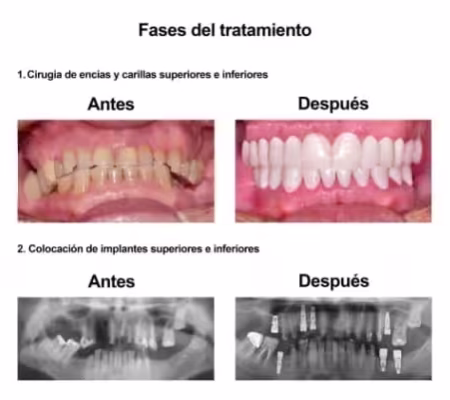 Rehabilitacion Oral e implantes dentales Smiles Peru (4) Rehabilitacion Oral e implantes dentales Smiles Peru (4)