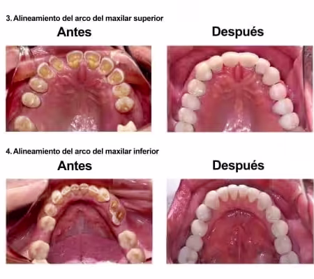 Rehabilitacion Oral e implantes dentales Smiles Peru (5) Rehabilitacion Oral e implantes dentales Smiles Peru (5)