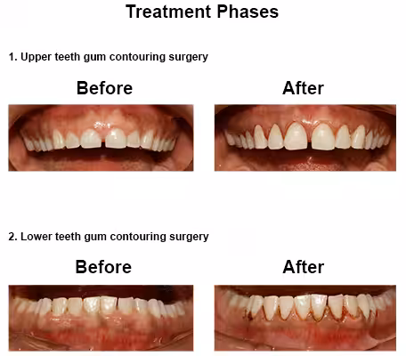 angelica-case-study-slide4-en Gingivoplasty Smiles Peru