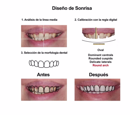 Smiles Peru Portofolio Carillas Dentales (1) Smiles Peru Portofolio Carillas Dentales (1)