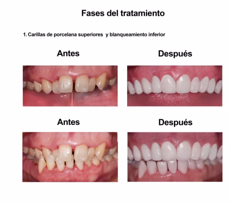 Smiles Peru Portofolio Carillas Dentales (2) Smiles Peru Portofolio Carillas Dentales (1)