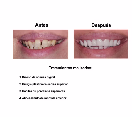 Smiles Peru Portofolio Carillas Dentales (4) Smiles Peru Portofolio Carillas Dentales (1)