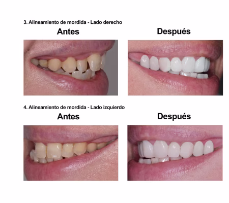 Smiles Peru Portofolio Carillas Dentales (6) carillas dentales Smiles Peru