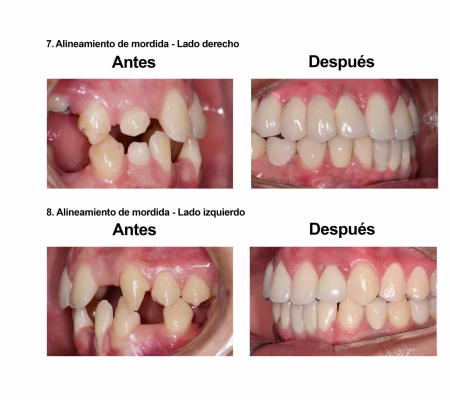 implantes dentales coronas porcelana Smiles Peru (1) implantes dentales coronas porcelana Smiles Peru (1)