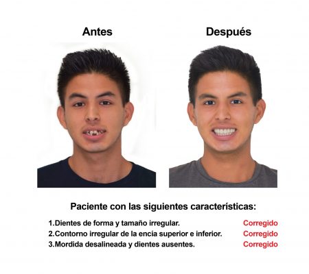 implantes dentales coronas porcelana Smiles Peru (2)