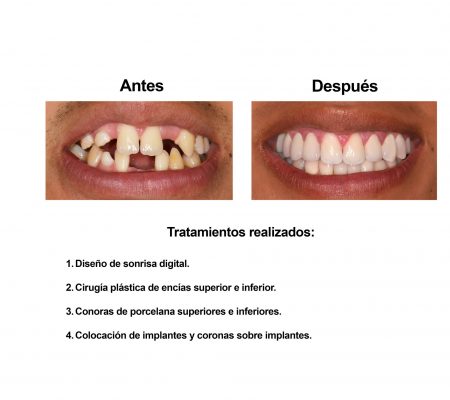 implantes dentales coronas porcelana Smiles Peru (3)