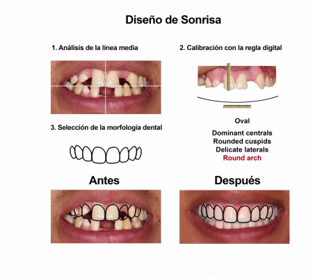 implantes dentales coronas porcelana Smiles Peru (4) implantes dentales coronas porcelana Smiles Peru (4)
