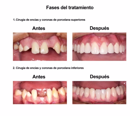 implantes dentales coronas porcelana Smiles Peru (5) implantes dentales coronas porcelana Smiles Peru (5)