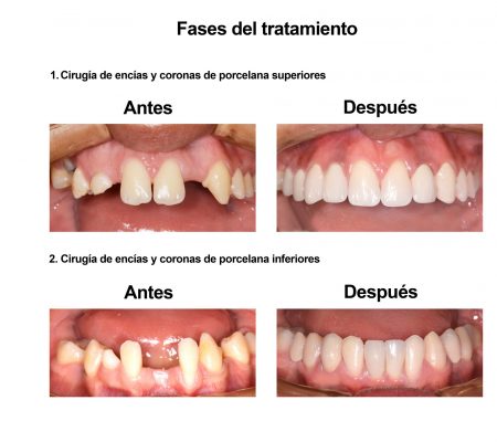 implantes dentales coronas porcelana Smiles Peru (5)