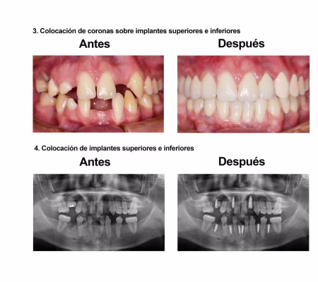 implantes dentales coronas porcelana Smiles Peru (6) implantes dentales coronas porcelana Smiles Peru (6)