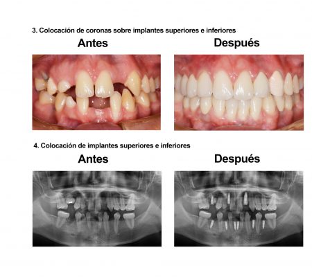 implantes dentales coronas porcelana Smiles Peru (6)