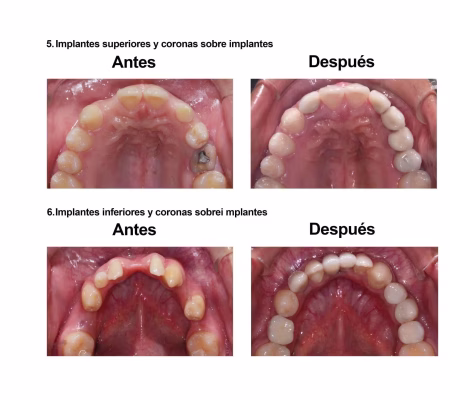 implantes dentales coronas porcelana Smiles Peru (7) implantes dentales coronas porcelana Smiles Peru (7)