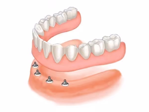 Sobredentadura Ball-retained Dentures Smiles Peru