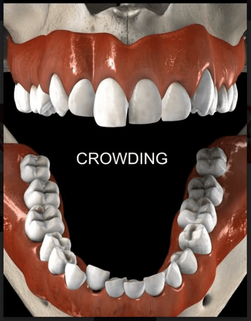 Smiles Peru Ortodoncia Apiñamiento Crowding Dental