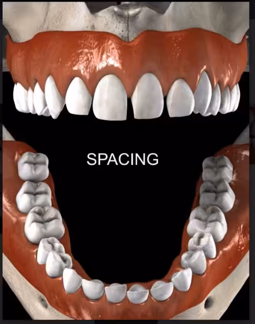 Diastema-Spacing-Dental-Smiles-Peru Diastema-Spacing-Dental-Smiles-Peru