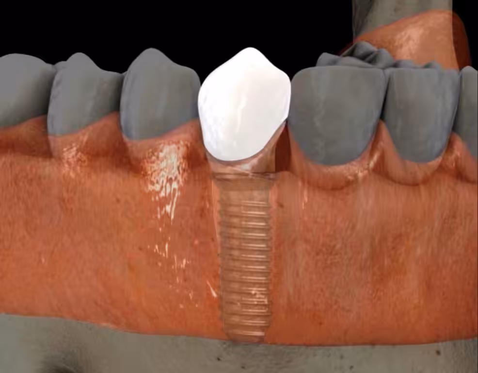 Implant and Crown Smiles Peru Dental