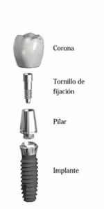 cemented implant crown.jpg cemented implant crown