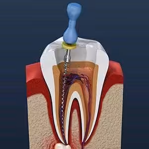 Endodoncia Smiles Peru1 Endodoncia Smiles Peru1