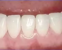 Dental Bondings-Despues Dental Bondings-Despues