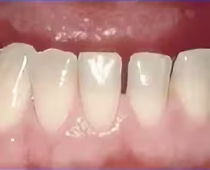 Dental Bondings-antes Dental Bondings-antes