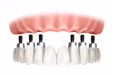 Dientes de porcelana sobre implantes