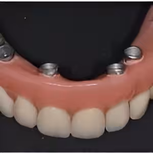 Prótesis híbrida sobre implantes Prótesis híbrida sobre implantes
