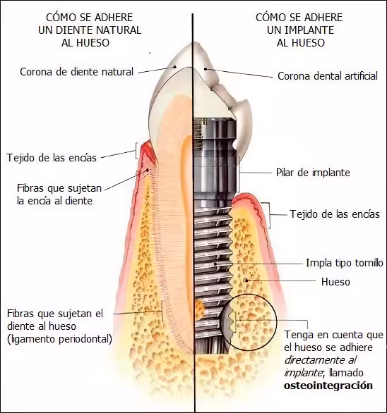 osseointegration_clipdrop-enhance-01