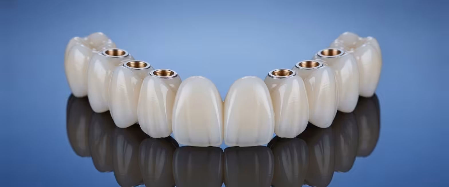 Implant supported porcelain teeth Puente Fijo de Porcelana soportado por 6 Implantes.